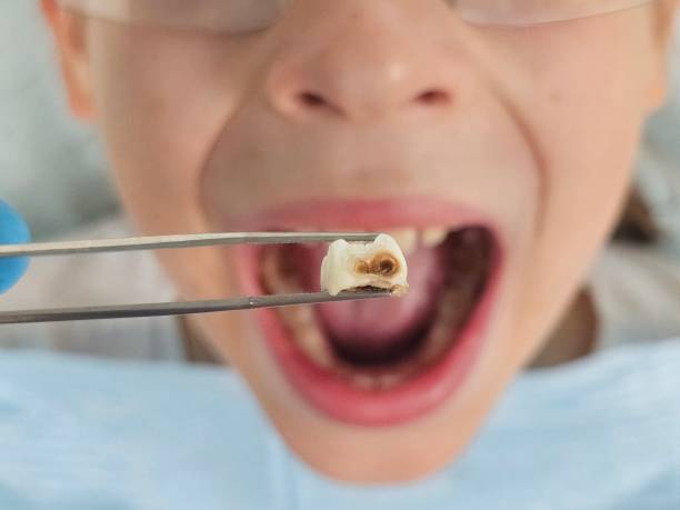 Best Emergency Tooth Extraction in Notasulga, AL